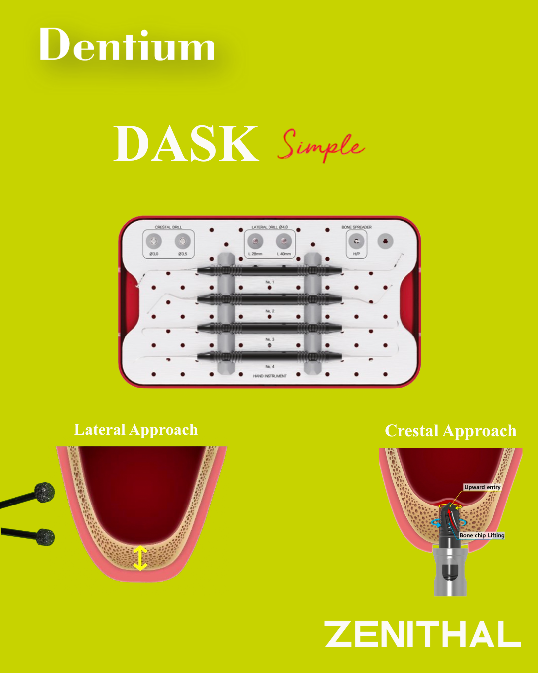 DASK, Dentium Advanced Sinus Kit, en la Elevación de Seno: Cómo Prevenir las Complicaciones y Reducir la Perforación de la Membrana